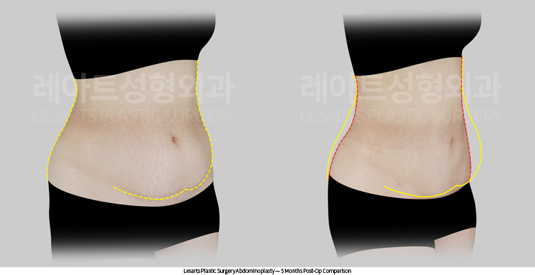 tummy_tuck_02_03_250811