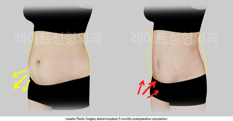 tummy_tuck_02_04_250804