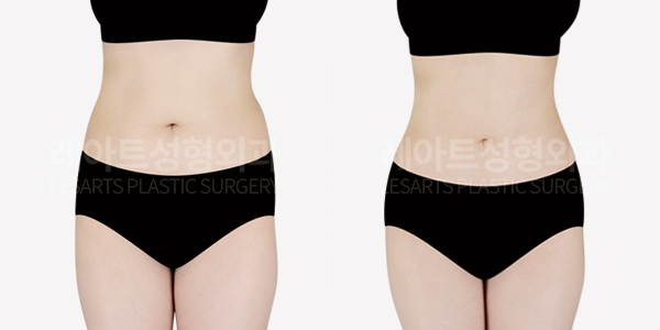 upper_body_liposuction_01_thumbnail_250709