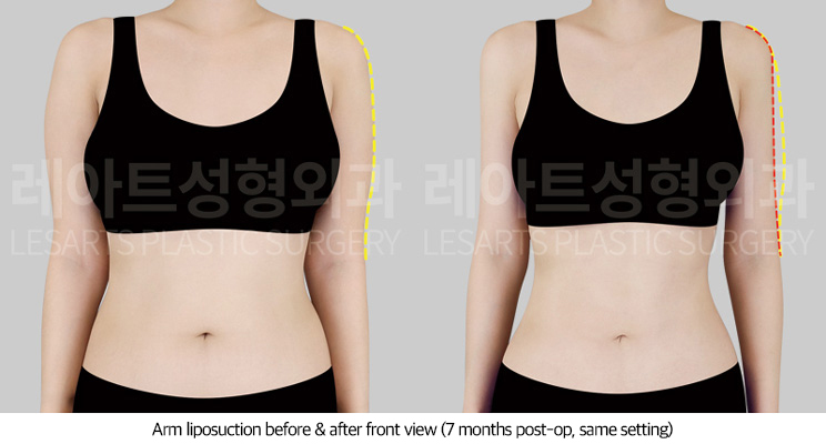 upper_body_liposuction_02_03_250709
