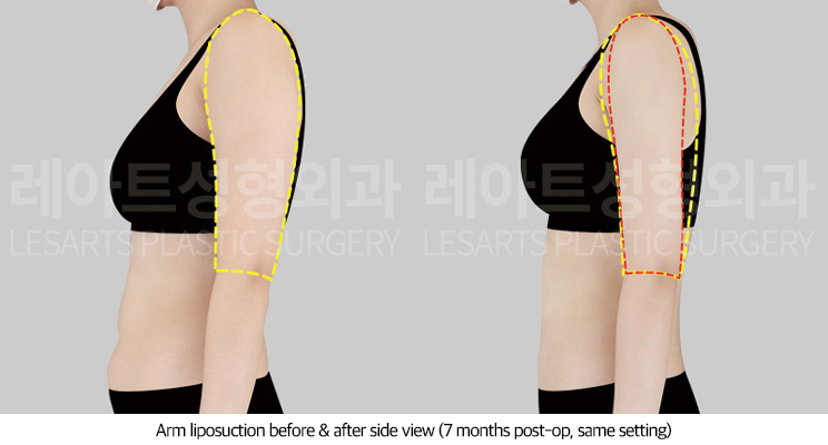 upper_body_liposuction_02_05_250709