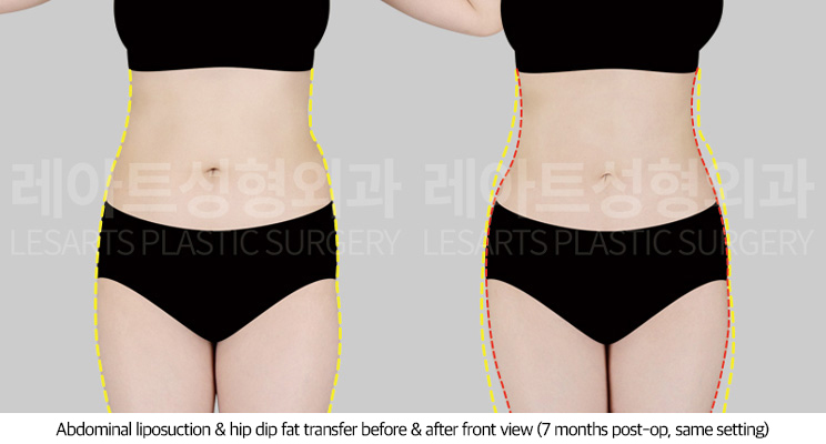 upper_body_liposuction_02_07_250709