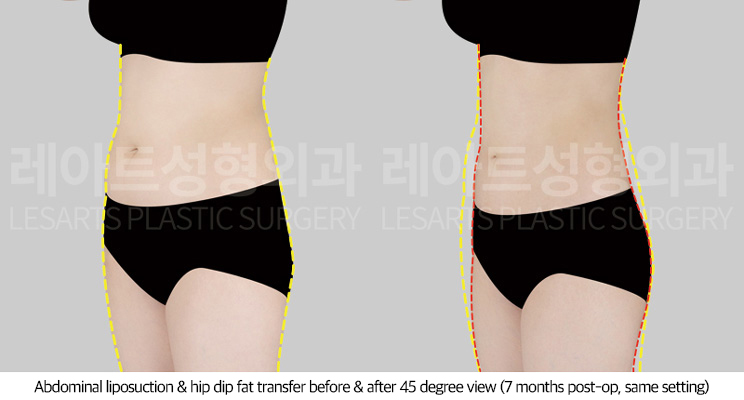 upper_body_liposuction_02_10_250709