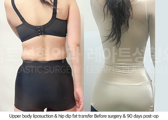 upper_body_liposuction_02_12_250709