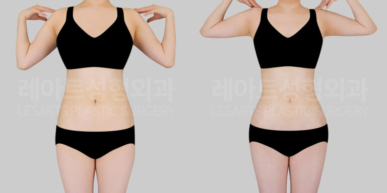 liposuction,abdominal liposuction
