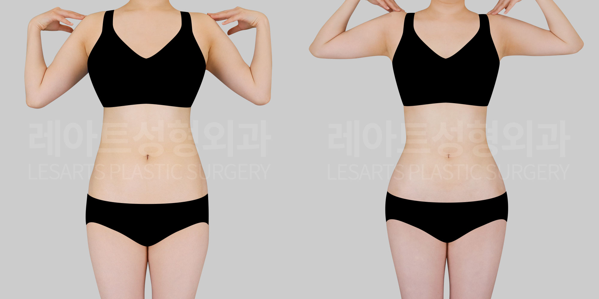liposuction,abdominal liposuction
