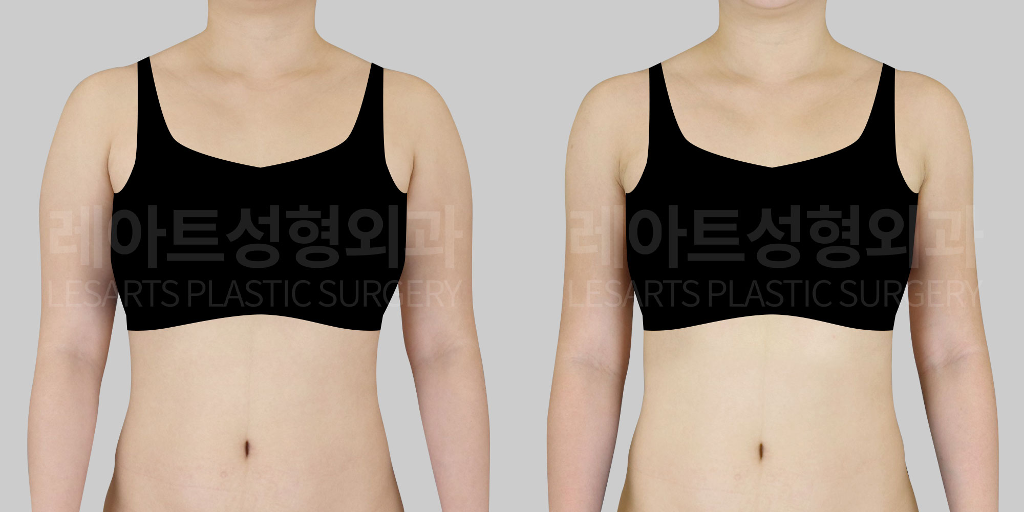 [Arm liposuction]How can you make muscular arms look even a little slimmer?