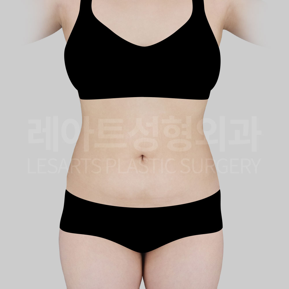 1_28323_abdominal_liposuction