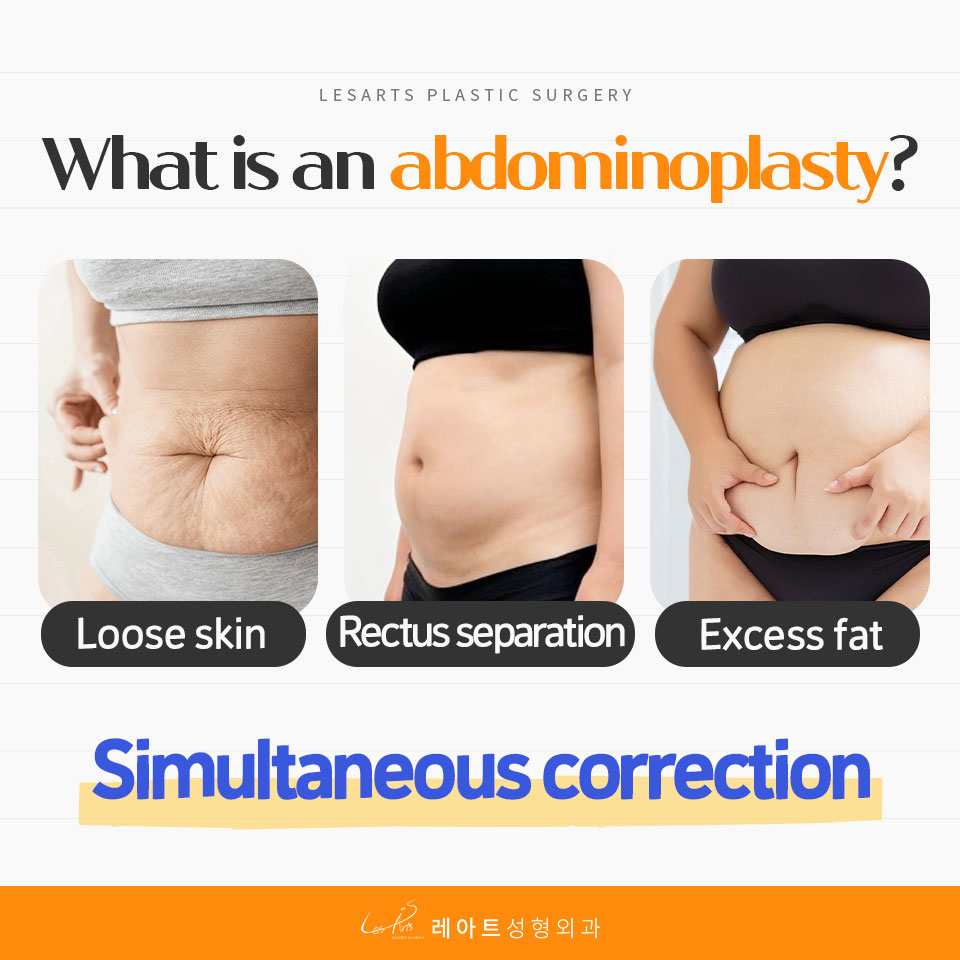 251125_abdominoplasty_post_01
