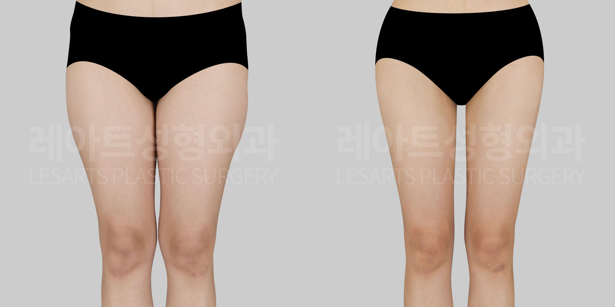 thigh liposuction, hip line