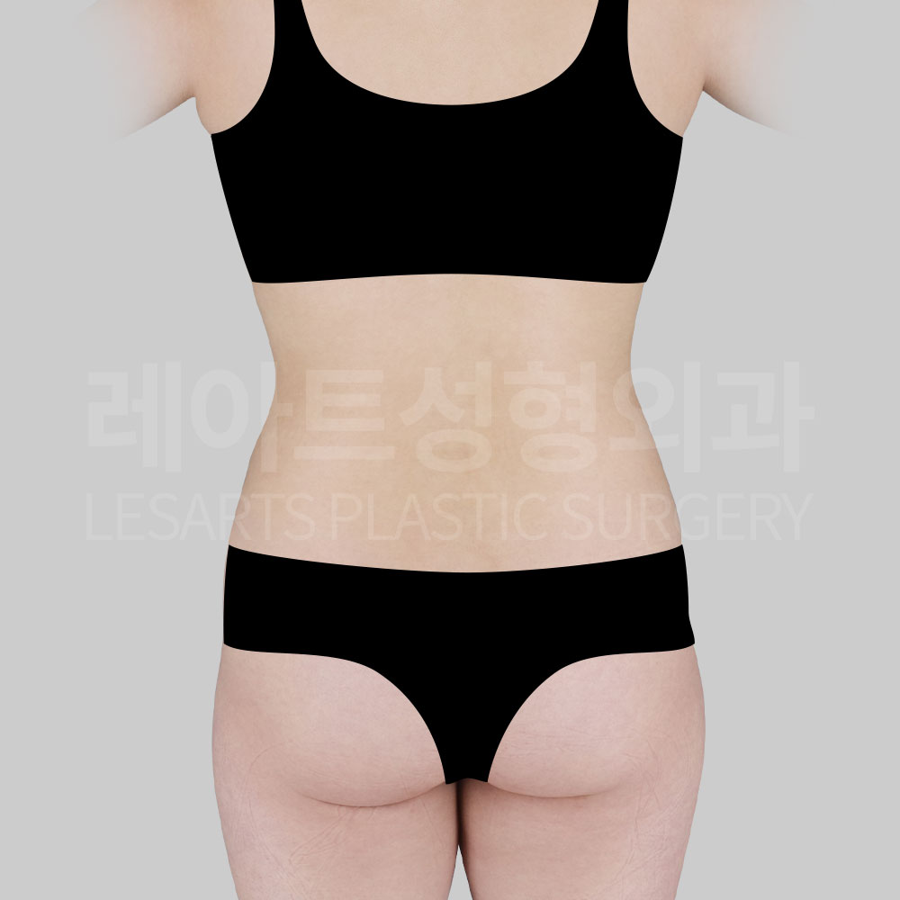 2_28323_abdominal_liposuction_back