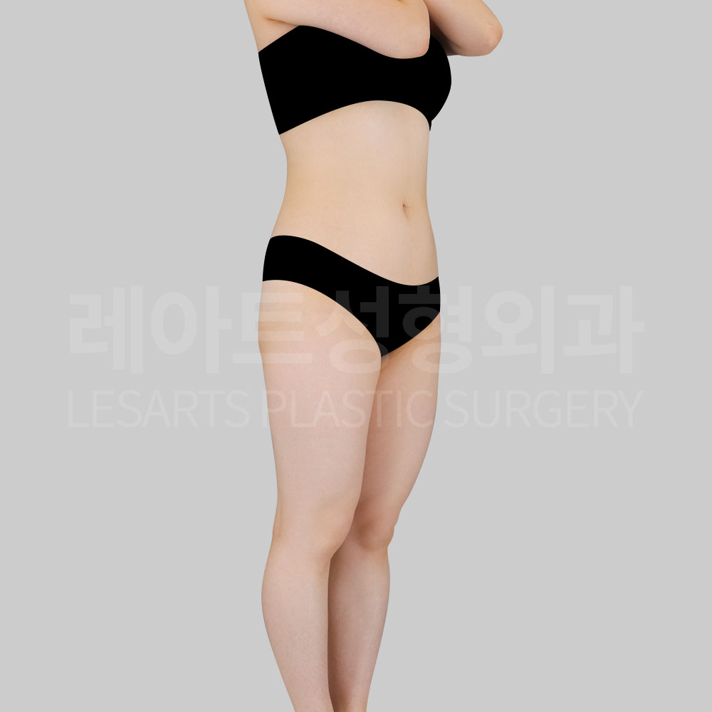 2_29075_abs_pelvic_liposuction