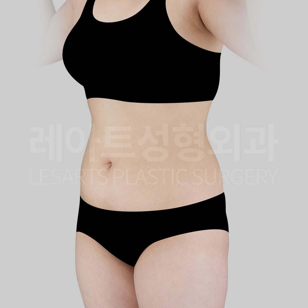 3_28323_abdominal_liposuction_45side