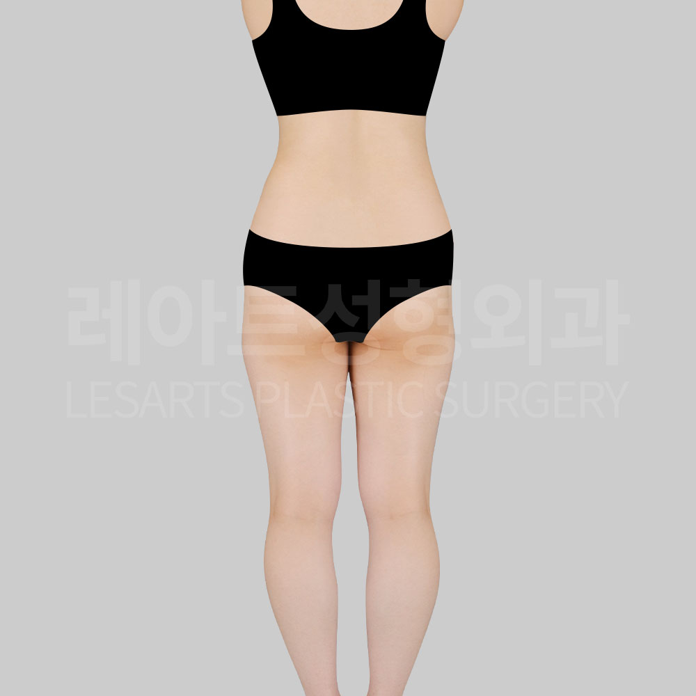 3_29075_abs_pelvic_liposuction
