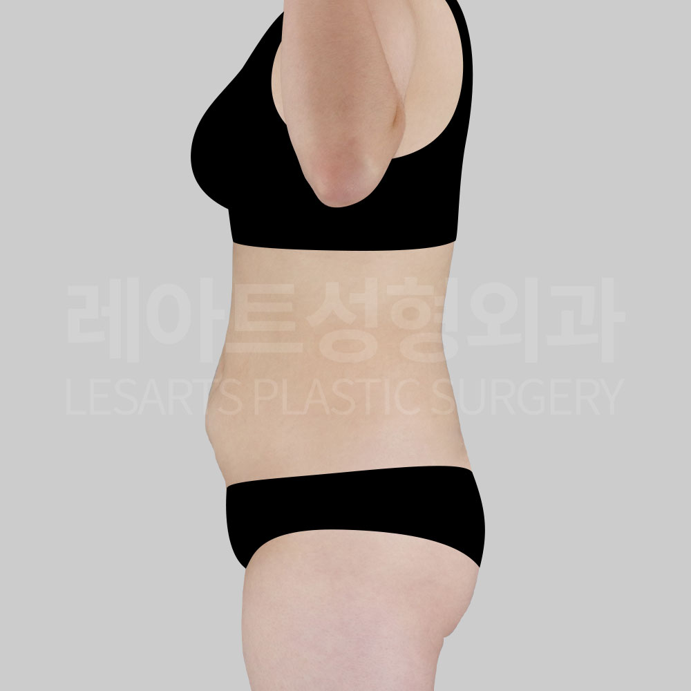 4_28323_abdominal_liposuction_side