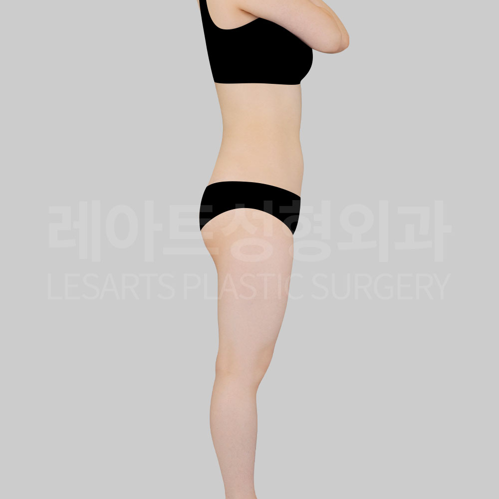 4_29075_abs_pelvic_liposuction