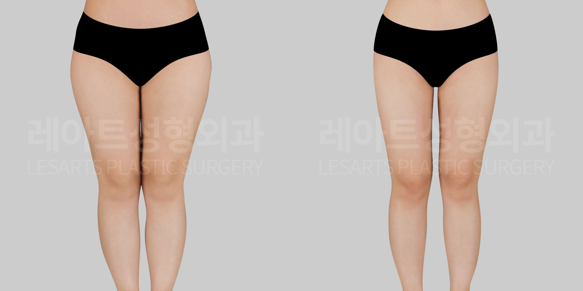 [Thigh liposuction]What is the line-improving effect of liposuction for lower-body obesity patients?
