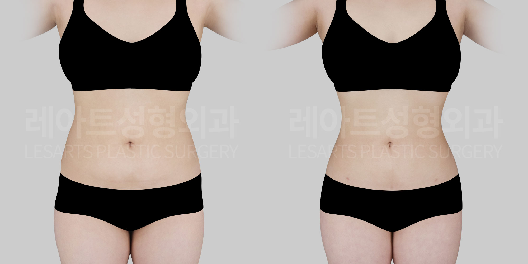 abdominal liposuction
