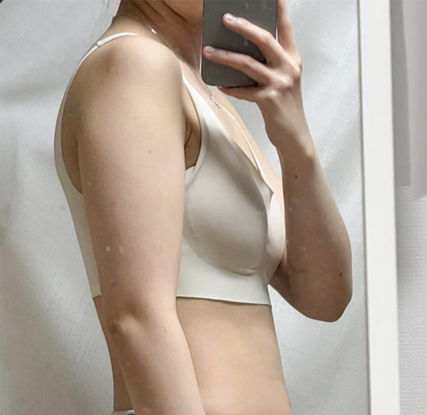 Osososool arm liposuction and accessory breast removal before photo in Korea – Lesarts Plastic Surgery