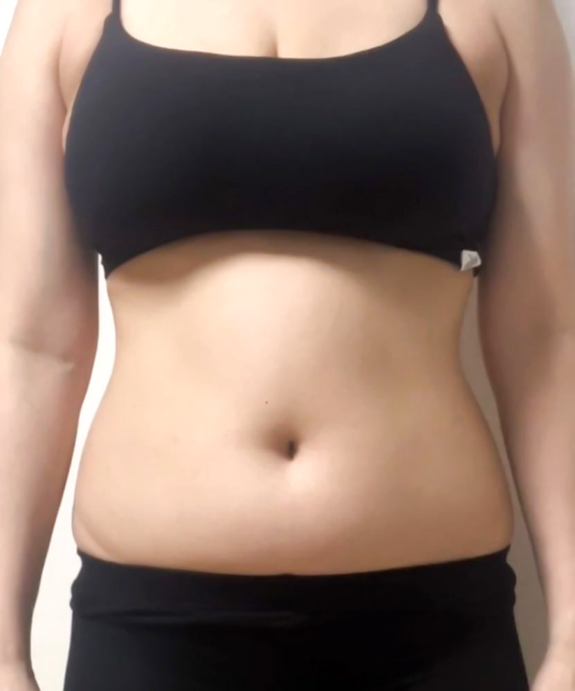 Yeoueoou abdominal liposuction before photo in Korea – Lesarts Plastic Surgery