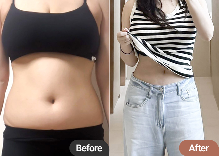 Yeoueoou abdominal liposuction before and after transformation – Best Liposuction Clinic in Korea Lesarts