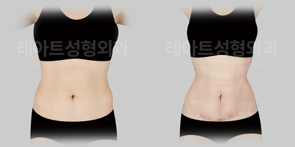abdominoplasty_01_thumbnail_250825