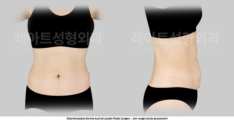 abdominoplasty_02_01_250825