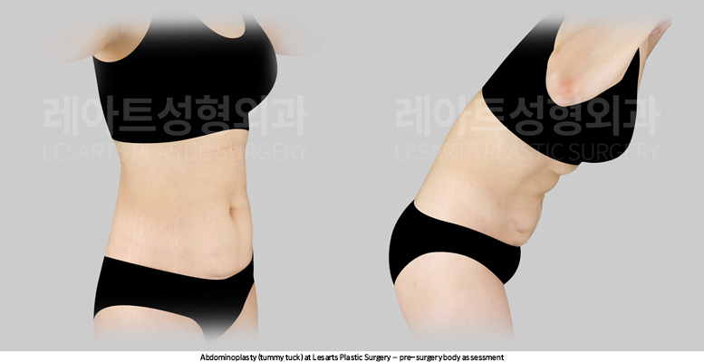 abdominoplasty_02_02_250825