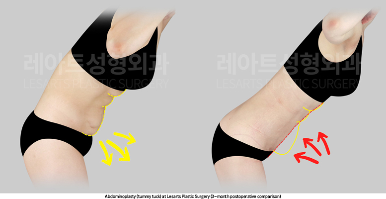 abdominoplasty_02_04_250825