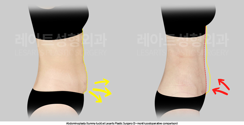 abdominoplasty_02_06_250825