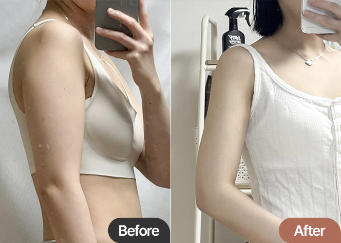 Osososool arm liposuction and accessory breast removal before and after comparison – Best Liposuction Clinic in Korea Lesarts