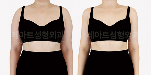 arm_liposuction_01_thumbnail_250819