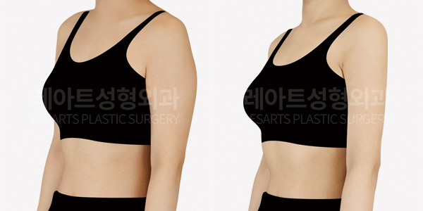 arm_liposuction_01_thumbnail_250822