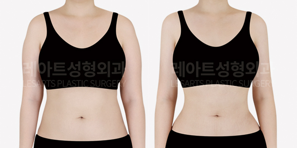 arm_liposuction_01_thumbnail_250828