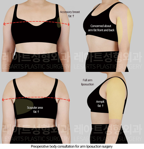 arm_liposuction_02_01_250819