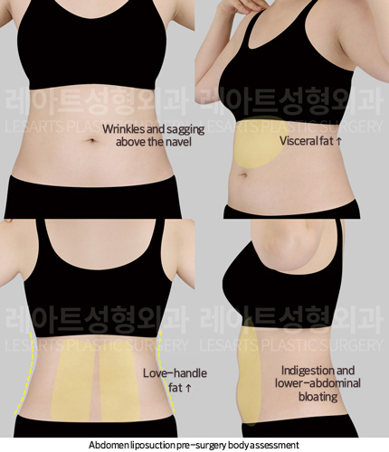 arm_liposuction_02_02_250828