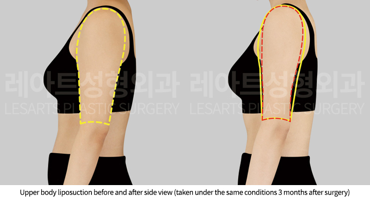 arm_liposuction_02_04_250822