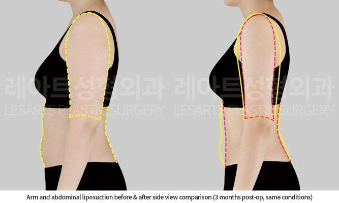 arm_liposuction_02_05_250828