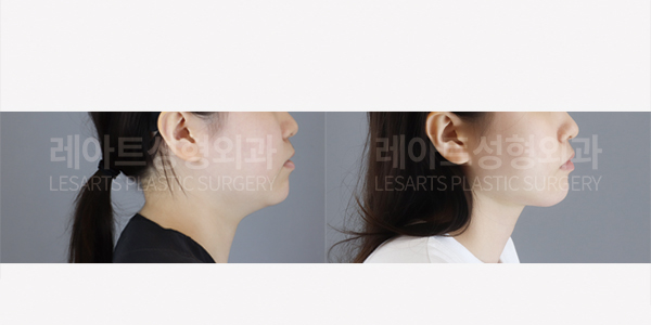facial_liposuction_01_thumbnail_250821