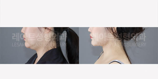 facial_liposuction_01_thumbnail_250828