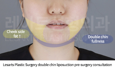 facial_liposuction_02_01_250821
