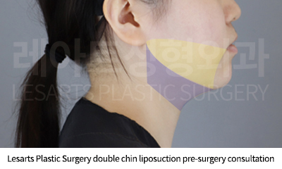facial_liposuction_02_02_250821