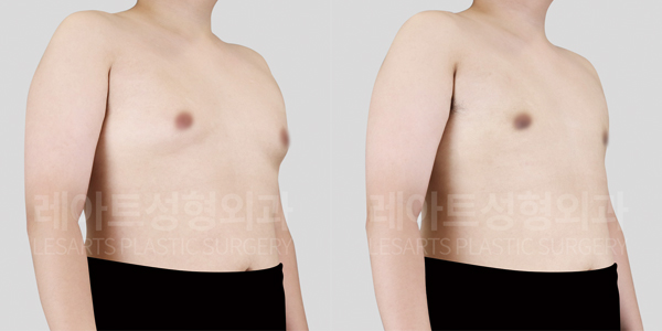 gynecomastia_01_thumbnail_250820