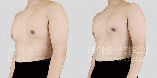 gynecomastia_01_thumbnail_250827