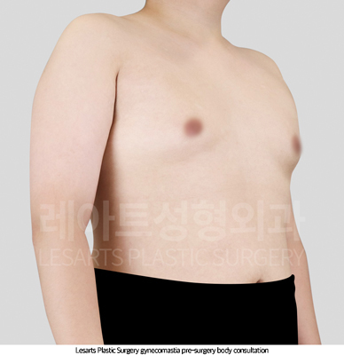 gynecomastia_02_01_250820