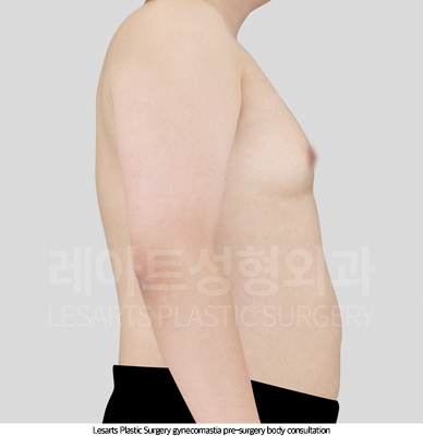 gynecomastia_02_02_250820