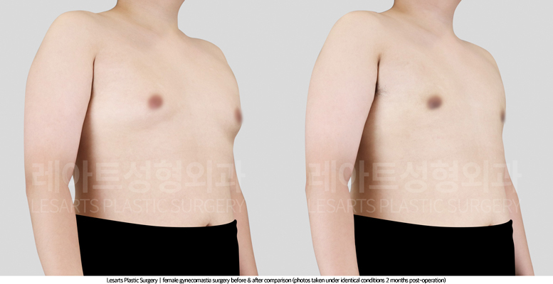 gynecomastia_02_03_250820