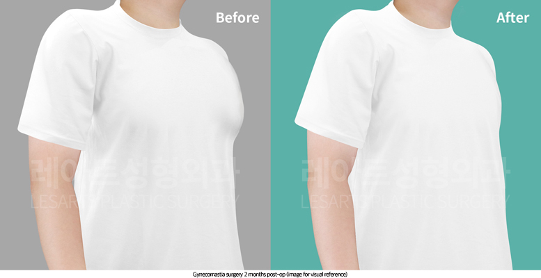 gynecomastia_02_05_250820