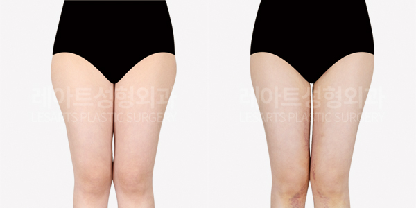 thigh_liposuction_01_thumbnail_250814