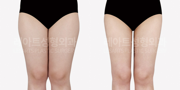 thigh_liposuction_01_thumbnail_250826